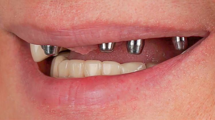 Before - Wash Common Dental