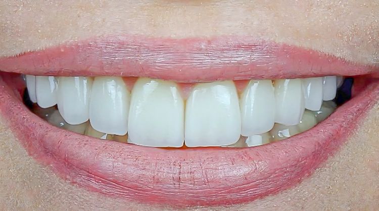 After -Wash Common Dental