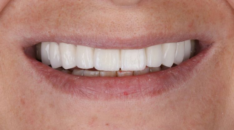 After -Wash Common Dental