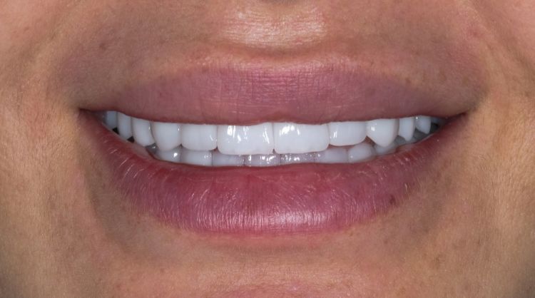 After -Wash Common Dental